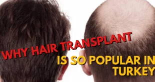 Why Hair Transplant popular in Turkey